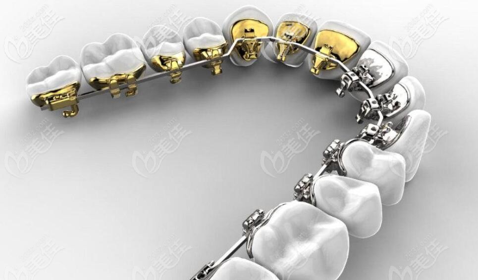 舌側(cè)隱形矯正展示圖 舌側(cè)隱形矯正展示圖