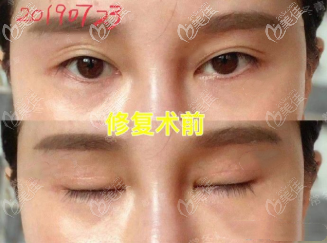 做雙眼皮修復(fù)前