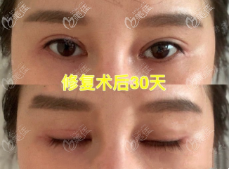 重慶北部寬仁整形三眼皮修復(fù)案例