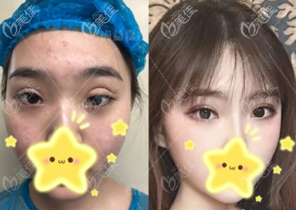 秦偉醫(yī)生雙眼皮寬改窄+肉條感修復(fù)效果圖