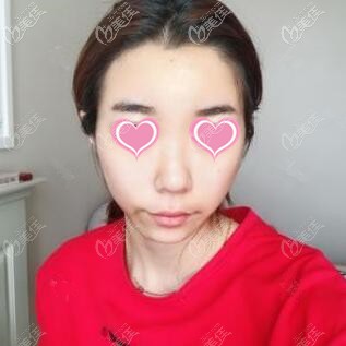 玻尿酸填充面部術(shù)前照 玻尿酸填充面部術(shù)前照