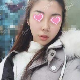 太陽穴臉頰都凹陷的我填充了2支伊婉C玻尿酸后得到改善，沒有出現(xiàn)脹痛等感覺！