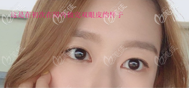 這是我在國內做全切雙眼皮的樣子 這是我在國內做全切雙眼皮的樣子