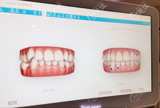 登特口腔的口掃結果