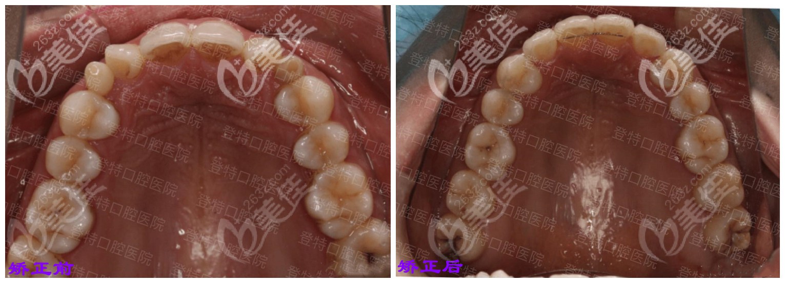 網友在福州登特矯正后的前后對比