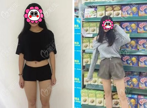 武漢仁愛(ài)時(shí)光5g天使光雕大腿吸脂