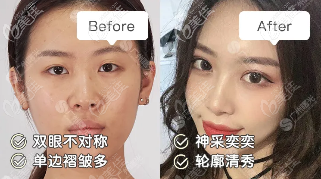 廣州曙光雙眼皮修復(fù)醫(yī)生范丹醫(yī)生實例 廣州曙光雙眼皮修復(fù)醫(yī)生范丹醫(yī)生實例