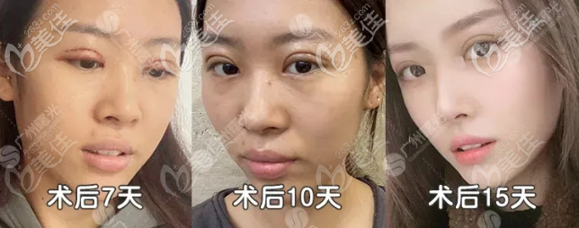 廣州曙光雙眼皮修復(fù)實例療效圖 廣州曙光雙眼皮修復(fù)實例療效圖
