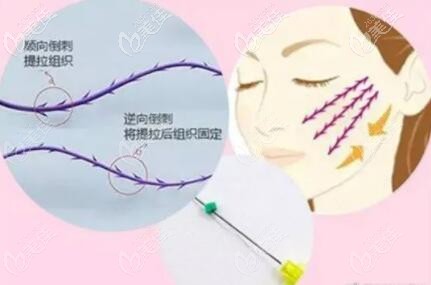 埋線提升線材展示