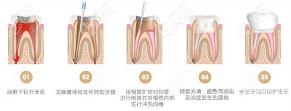 根管治療的步驟過程