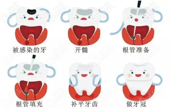 牙齒做完根管后需做牙冠