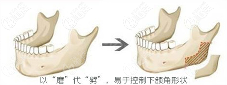下頜角截骨以“磨”代“”劈