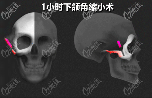 <!--<i data=20240703-sp></i>-->醫(yī)生一小時(shí)下頜角縮小術(shù)