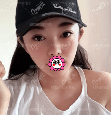 在北京華韓做歐洲之星Fotona 4D面部提拉10多天了 在北京華韓做歐洲之星Fotona 4D面部提拉10多天了