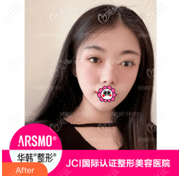 做歐洲之星面部提拉間隔一個(gè)月又做了一次,做完兩次后效果更是好點(diǎn)