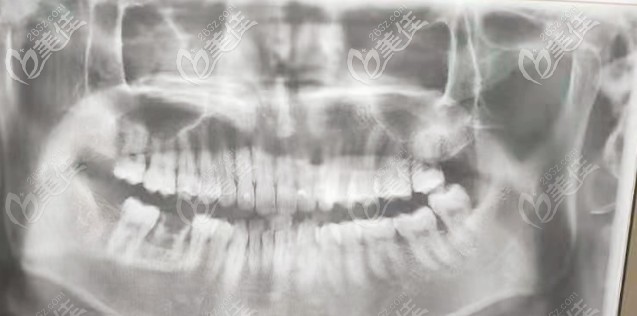 牙齒檢查拍的片 牙齒檢查拍的片