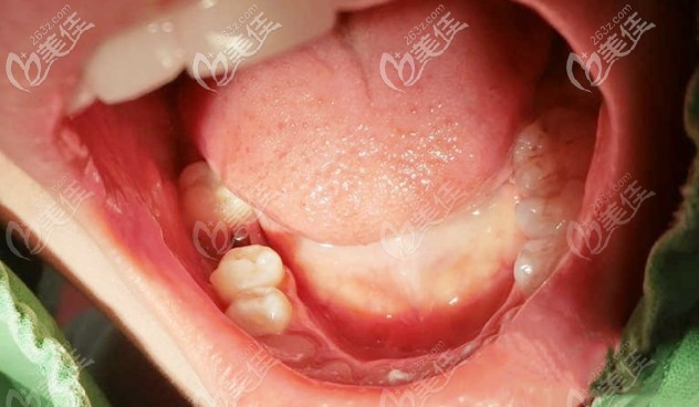 牙齒剛剛裝上基臺時 牙齒剛剛裝上基臺時