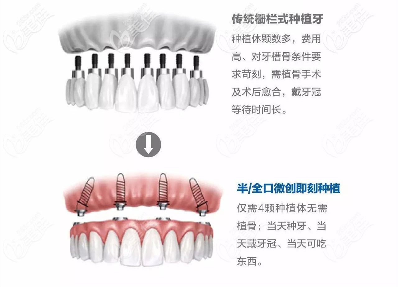 即刻種植牙和傳統(tǒng)對比 即刻種植牙和傳統(tǒng)對比