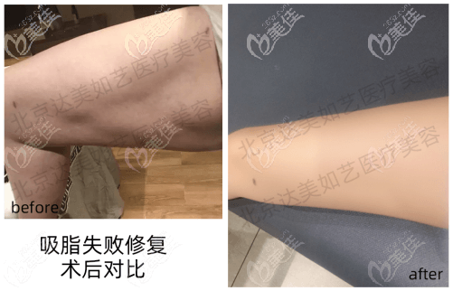 北京達(dá)美如藝大腿吸脂失敗修復(fù)案例反饋:凹凸不平等情況改善了