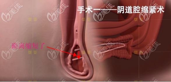 生物束帶私密緊縮術(shù)之陰道腔緊縮術(shù)步驟四