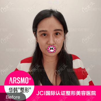 做熱拉提plus美膚前 做熱拉提plus美膚前