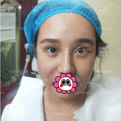 做熱拉提感覺不疼就是臉熱乎乎的 做熱拉提感覺不疼就是臉熱乎乎的