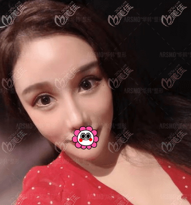 問我做熱拉提PLUS的時(shí)候啥感覺,就是臉熱熱的,整個(gè)過程也不疼