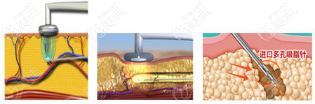 黃金微雕溶脂射頻溶脂過程示意圖