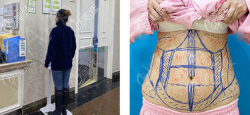 重慶時(shí)光整形全身吸脂手術(shù)4月有特價(jià)了！技術(shù)可以價(jià)格也不貴