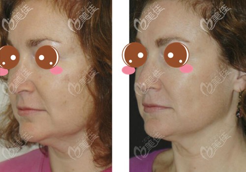 武漢藝星五代熱瑪吉治療后4個(gè)月對(duì)比照