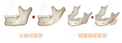 李湘原下頜角磨骨 李湘原下頜角磨骨
