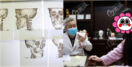 <!--<i data=20240703-sp></i>-->伊萊美李湘原面診下頜角手術(shù)講解圖 <!--<i data=20240703-sp></i>-->伊萊美李湘原面診下頜角手術(shù)講解圖