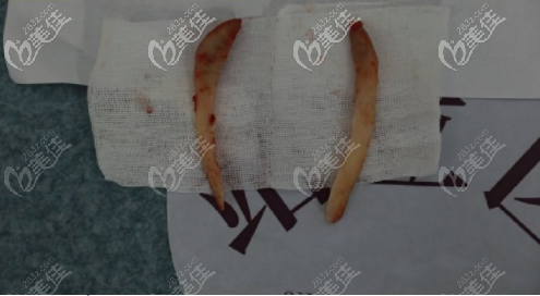 <!--<i data=20240703-sp></i>-->伊萊美李湘原下頜角手術(shù)截骨圖 <!--<i data=20240703-sp></i>-->伊萊美李湘原下頜角手術(shù)截骨圖