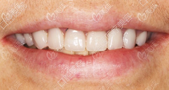 這是我們呼和浩特華醫(yī)口腔做的上半口種植牙案例,給大家展示下怎么樣