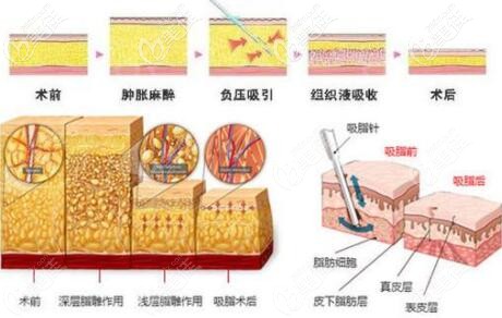 吸脂手術(shù)過程