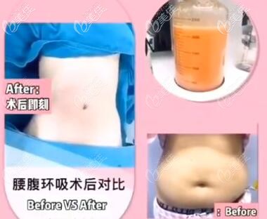 三亞維多利亞腰腹環(huán)吸真人前后對比照