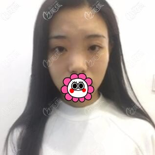 做耳軟骨復(fù)合隆鼻術(shù)前照 做耳軟骨復(fù)合隆鼻術(shù)前照