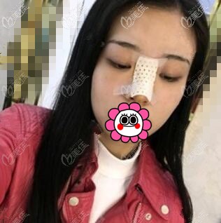 隆鼻術(shù)后2天照 隆鼻術(shù)后2天照