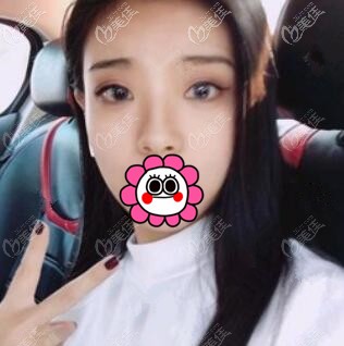 隆鼻術(shù)后9天照 隆鼻術(shù)后9天照