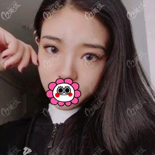 耳軟骨復(fù)合隆鼻術(shù)后20天照 耳軟骨復(fù)合隆鼻術(shù)后20天照