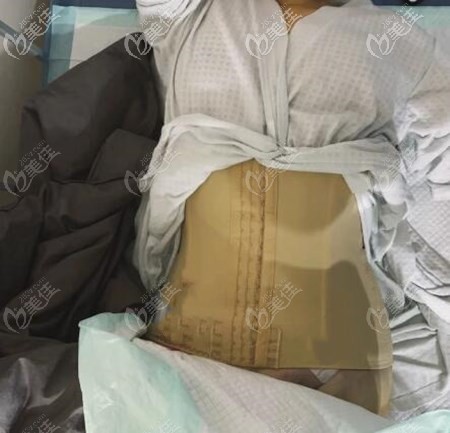 腰腹吸脂第3天效果圖