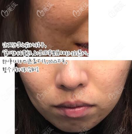 郴州曹家整形點陣激光祛痘坑治療前圖片 郴州曹家整形點陣激光祛痘坑治療前圖片