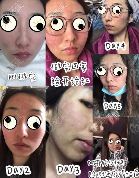 我在郴州曹家整形做過(guò)3次剝脫點(diǎn)陣激光祛痘坑,效果我挺滿意