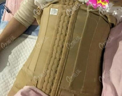 腰腹吸脂1-7天 恢復(fù)效果圖片