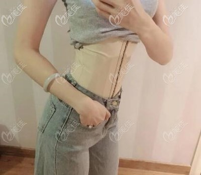 腰腹抽脂3000cc恢復(fù)25天效果圖