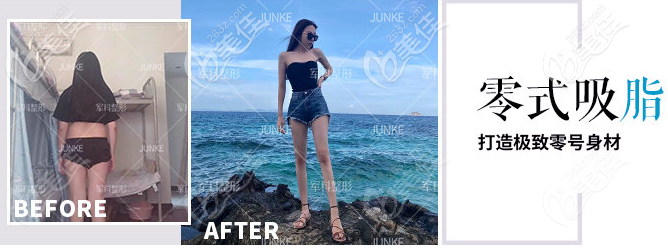 王科醫(yī)生零式大腿+腰腹環(huán)吸效果圖