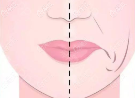 面部下垂示意圖