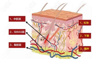 H2面部提塑術(shù)原理圖