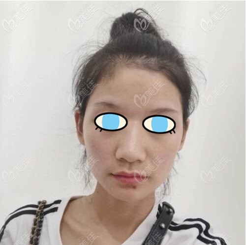 術(shù)前照片 術(shù)前照片