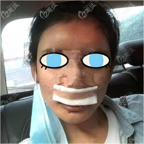 膨體隆鼻術(shù)后效果 膨體隆鼻術(shù)后效果